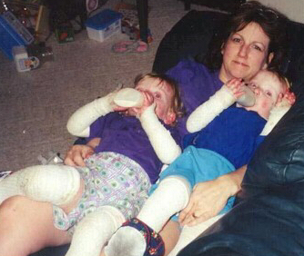 Connie with twins Samantha and Catherine, 2.5, RDEB